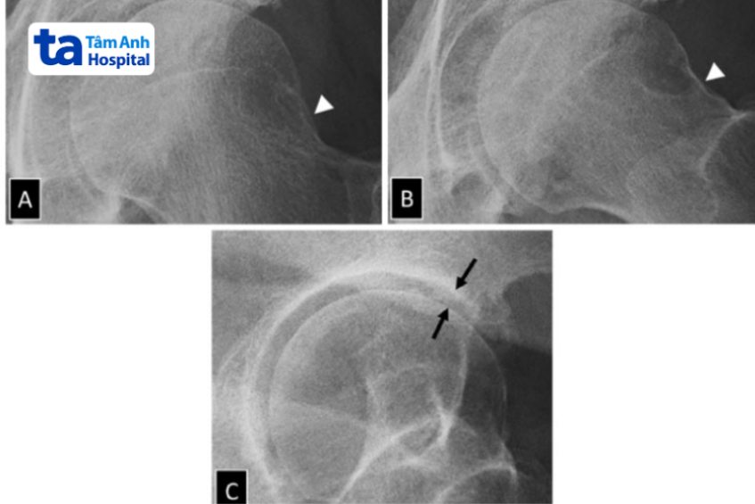 Hình ảnh viêm khớp háng trên X-quang