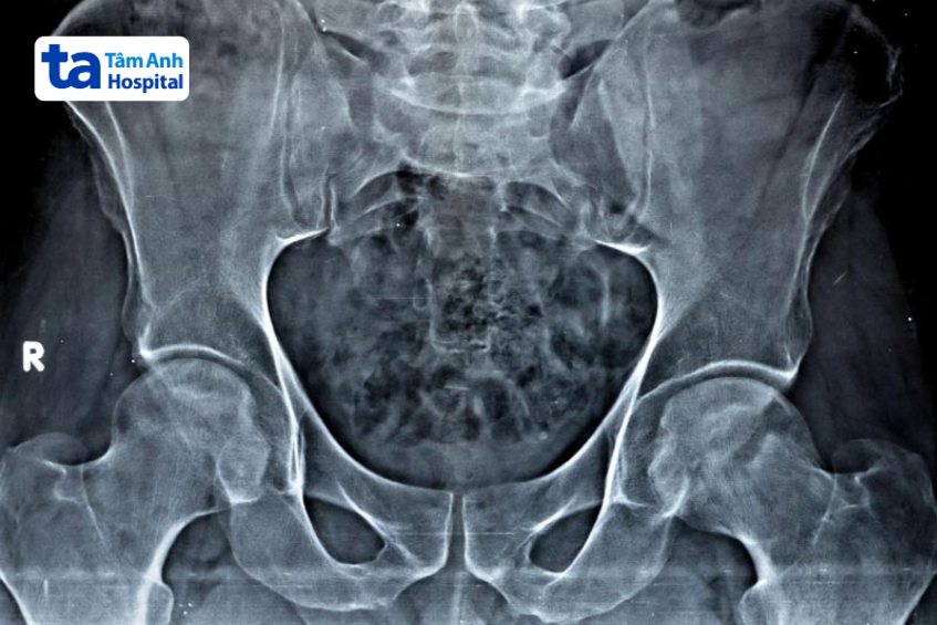 Hình ảnh viêm khớp háng trên X-quang