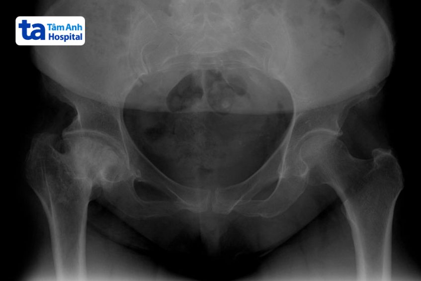Hình ảnh viêm khớp háng trên X-quang