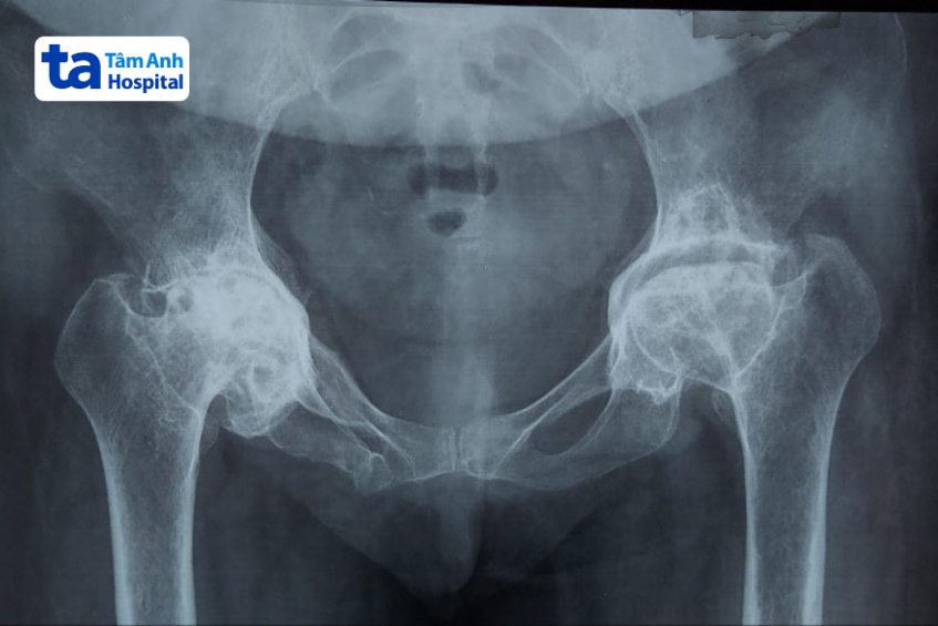 Hình ảnh viêm khớp háng trên X-quang