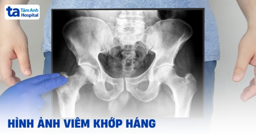 Hình ảnh viêm khớp háng qua từng giai đoạn tiến triển của bệnh
