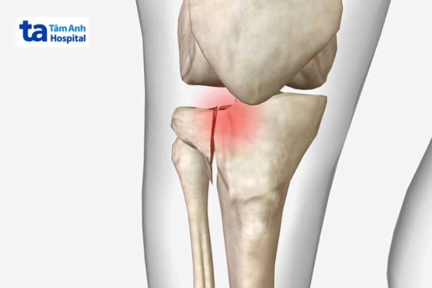 Hình ảnh vỡ xương mâm chày
