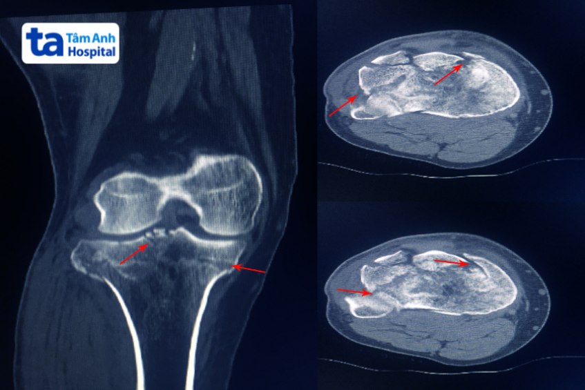 Hình ảnh X - quang mô tả xương mâm chày