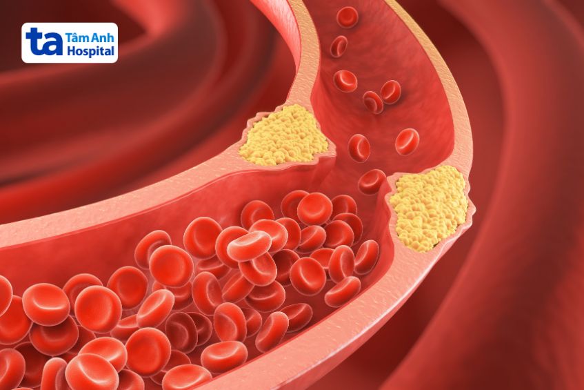 Tình trạng cholesterol cao có thể dẫn đến hình thành mảng xơ vữa động mạch