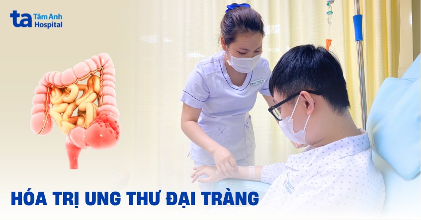 Hóa trị ung thư đại tràng là gì? Liệu trình, phác đồ và hiệu quả