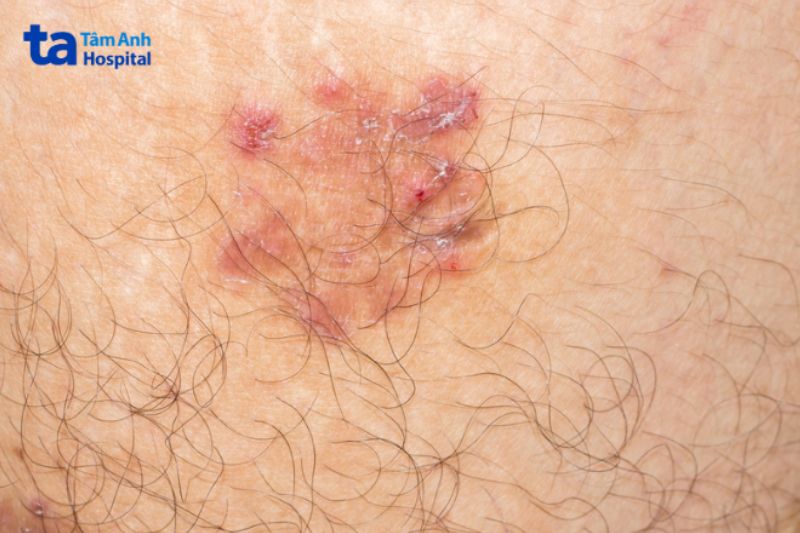 bệnh pemphigus