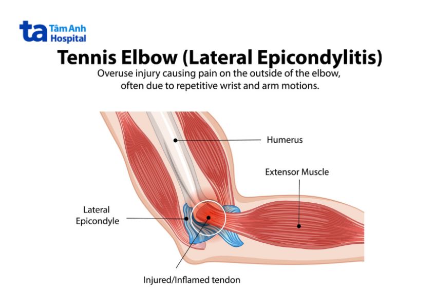 Hội chứng Tennis Elbow là gì?
