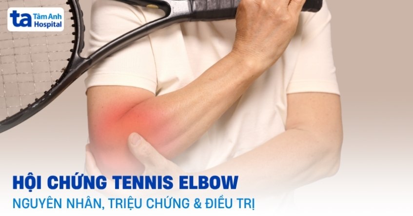 Hội chứng Tennis Elbow: Nguyên nhân, triệu chứng và điều trị