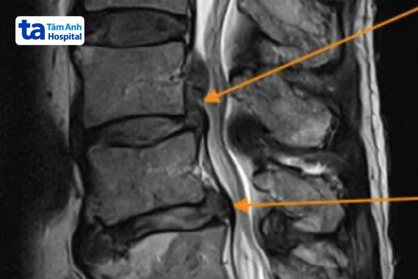 kết quả chụp x quang thoát vị đĩa đệm nặng
