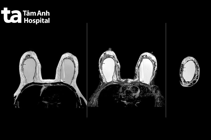Khám tầm soát ung thư vú