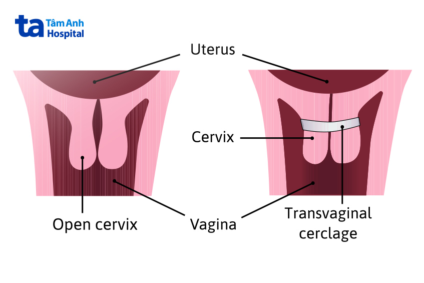 Khâu cổ tử cung cho thai đôi IVF giúp giảm nguy cơ sảy thai và sinh non