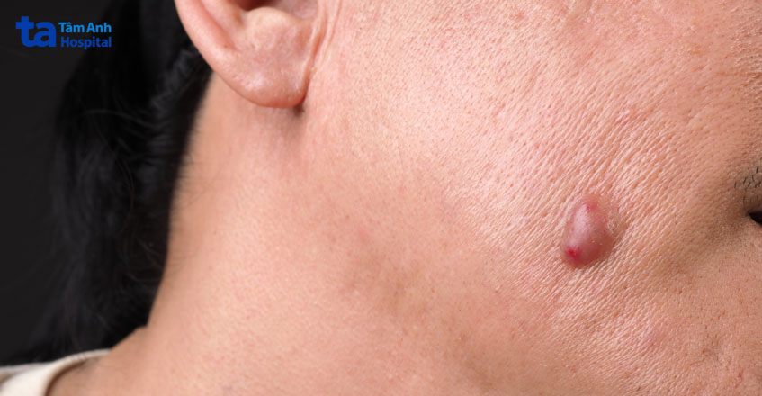 khi nặn không đúng cách có thể hình thành áp xe dưới da