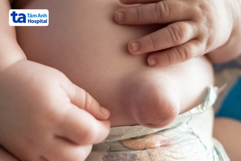 khi nào cần phẫu thuật thoát vị rốn