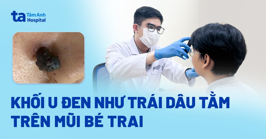 khối đen u như trái dâu tằm