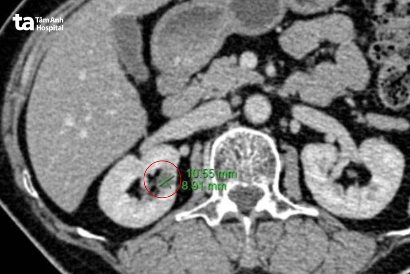 khối u 1cm qua chụp ct