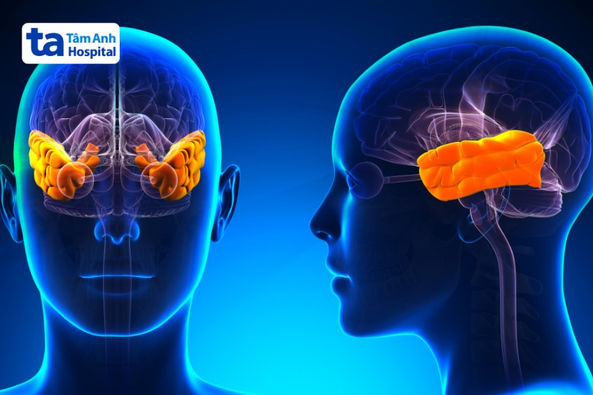 khối u màng não ở vùng thái dương