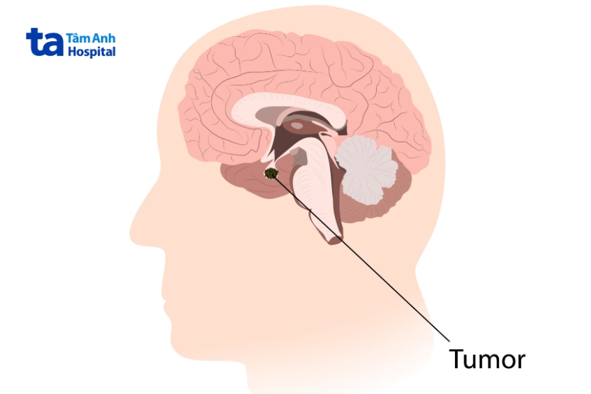 khối u sọ hầu lành tính nguy hiểm