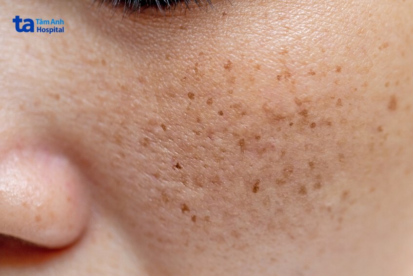 không bảo vệ da sau khi lăn kim