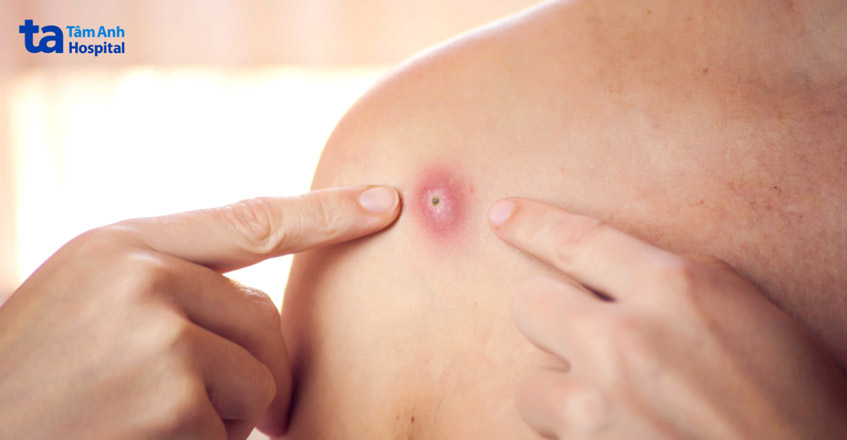 không được tự ý nặn mụn để tránh viêm nhiễm