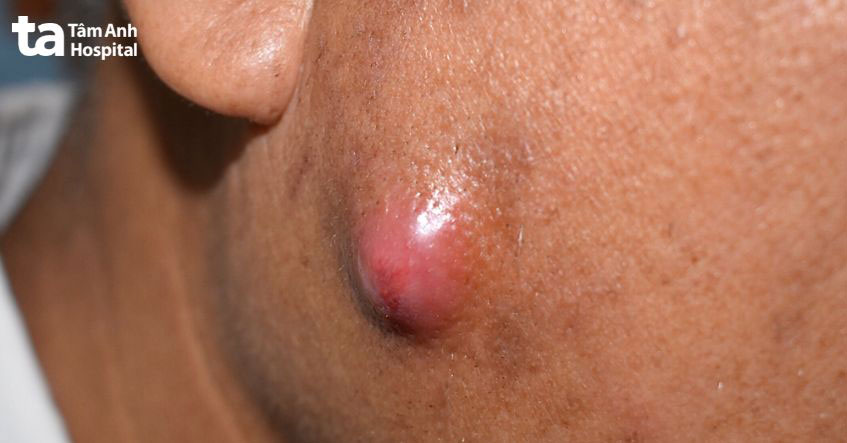 không tự ý chích rạch để tránh biến chứng