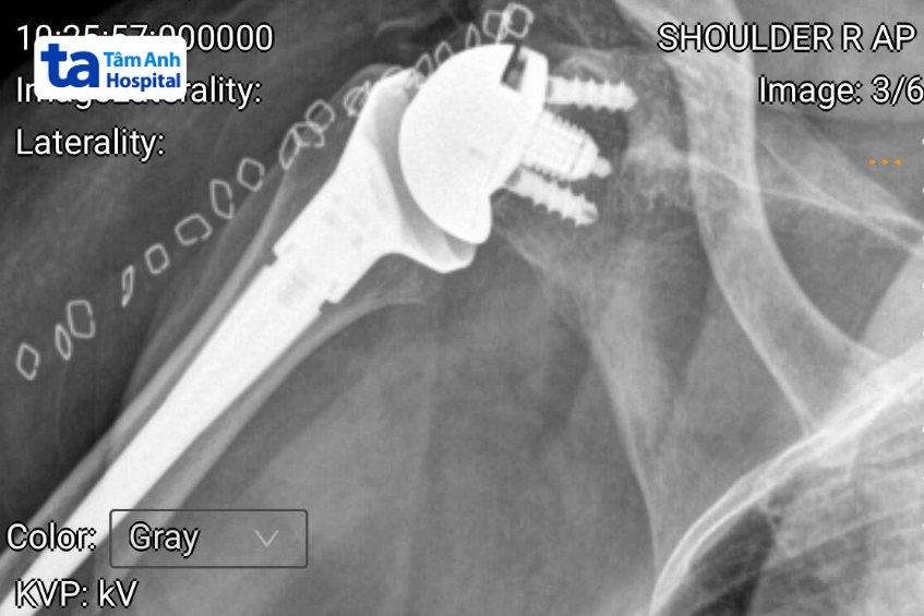 khớp vai bà kiều sau khi thay