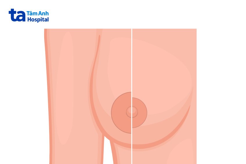 Kích thước trung bình của quầng vú