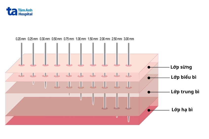 lăn kim sai kỹ thuật