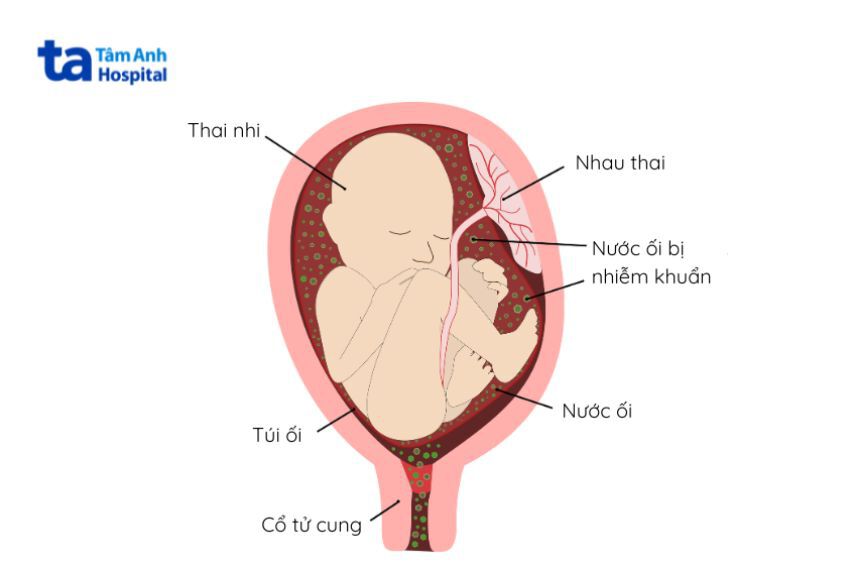 GBS có thể lây nhiễm từ mẹ sang trẻ sơ sinh trong quá trình chuyển dạ sinh ngả âm đạo, vì thế mẹ cần được điều trị dự phòng kháng sinh và trẻ sơ sinh cần được theo dõi sát sao sau sinh