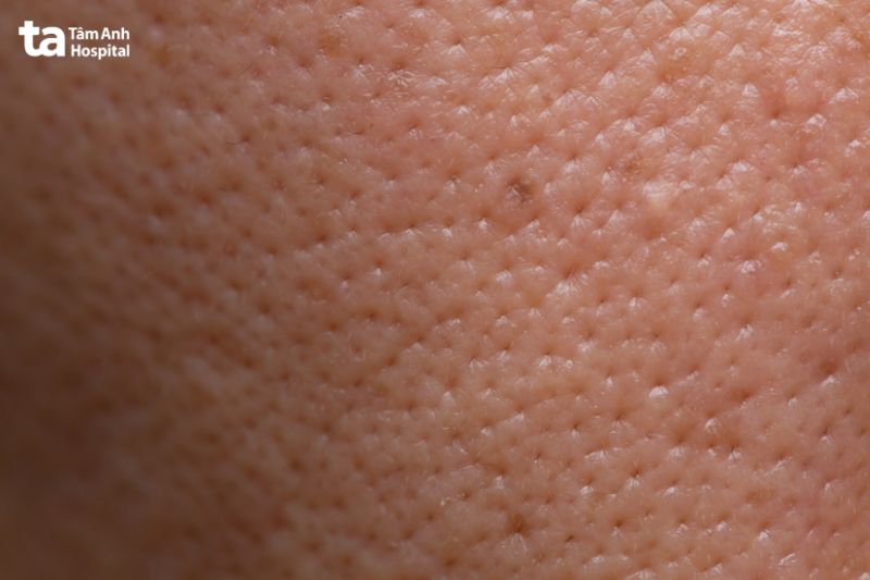 mặt là nơi dễ nhận thấy lỗ chân lông to