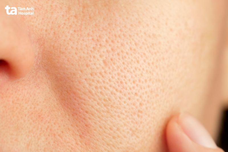 hình ảnh cận cảnh lỗ nang lông to ở má
