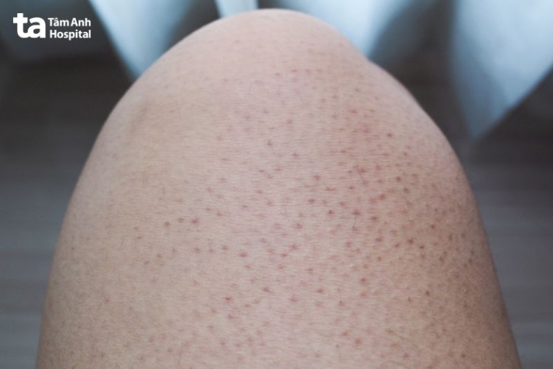 cạo hoặc tẩy lông sai cách làm to lỗ chân lông chân