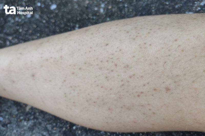 hình ảnh lỗ chân lông to ở chân