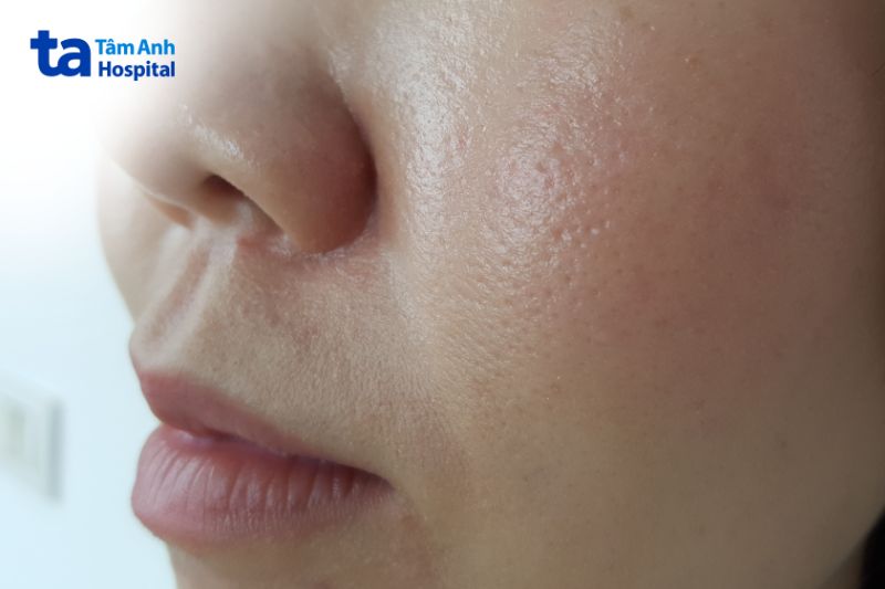 hình ảnh lỗ chân lông to ở má