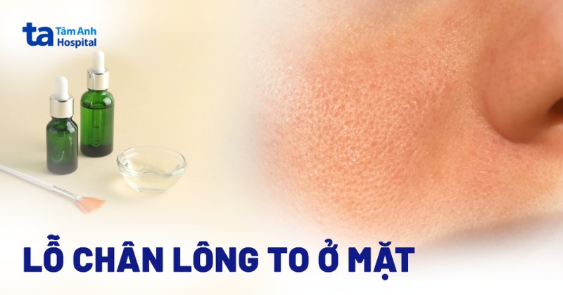 Lỗ chân lông to ở mặt: Cách khắc phục, nguyên nhân và phòng ngừa