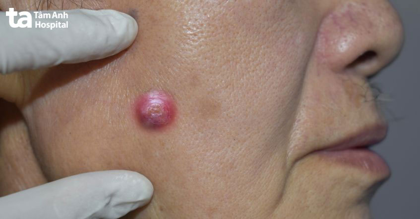lựa chọn thuốc bôi điều trị mụn nhọt phù hợp giúp giảm viêm