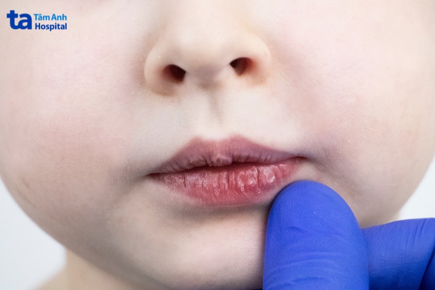 lưu ý khi xuất viện sau khi mổ tinh hoàn ẩn