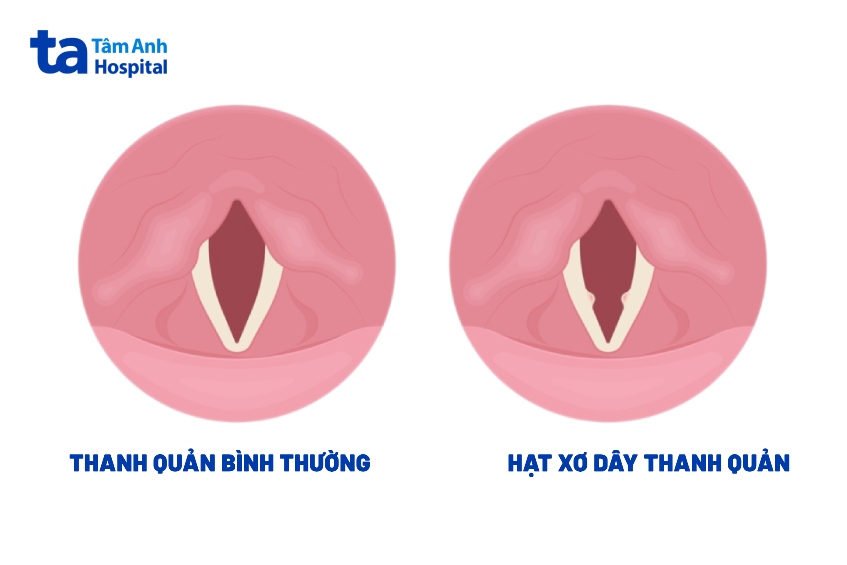 mắc bệnh hạt xơ dây thanh