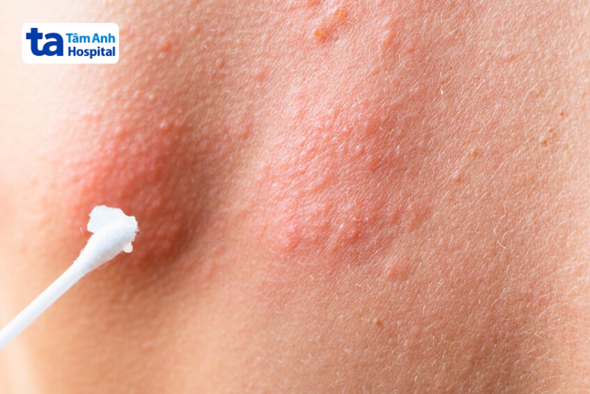 mắc bệnh zona bôi thuốc gì nhanh khỏi