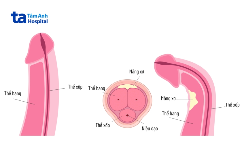 mảng bám hoặc mô sẹo hình thành dưới da dương vật