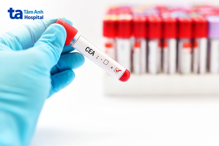 marker ung thư đại tràng cea