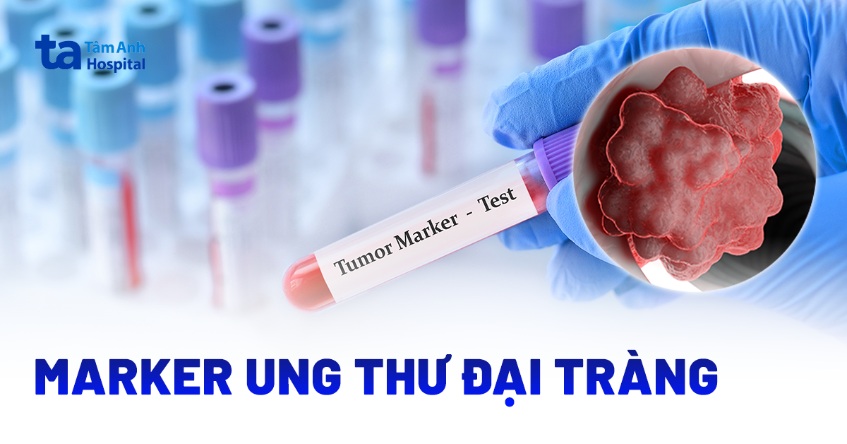 Marker ung thư đại tràng: Vai trò, chỉ định và phương pháp
