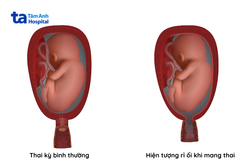 minh họa sự rò rỉ ối trong thai kỳ