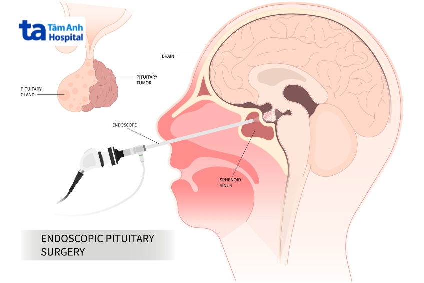 mổ nội soi u sọ hầu qua đường mũi