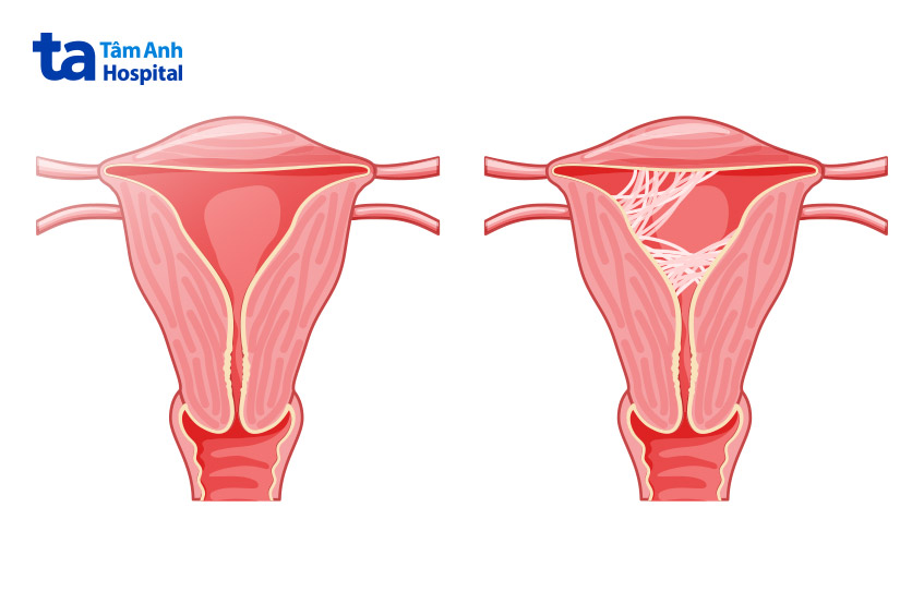 mô sẹo trong buồng tử cung