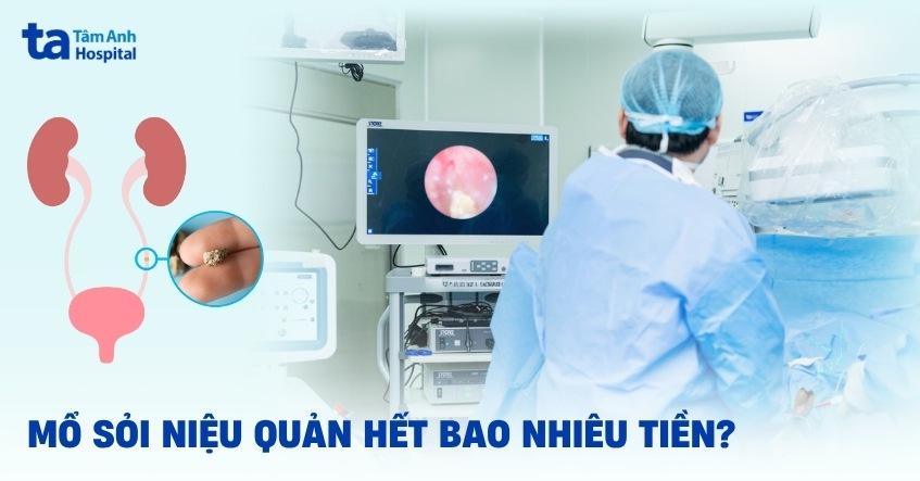 Mổ sỏi niệu quản hết bao nhiêu tiền? Chi phí có đắt không?