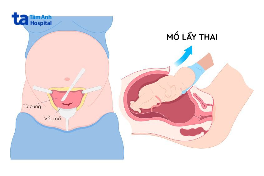 Mô tả phương pháp phẫu thuật mổ lấy thai