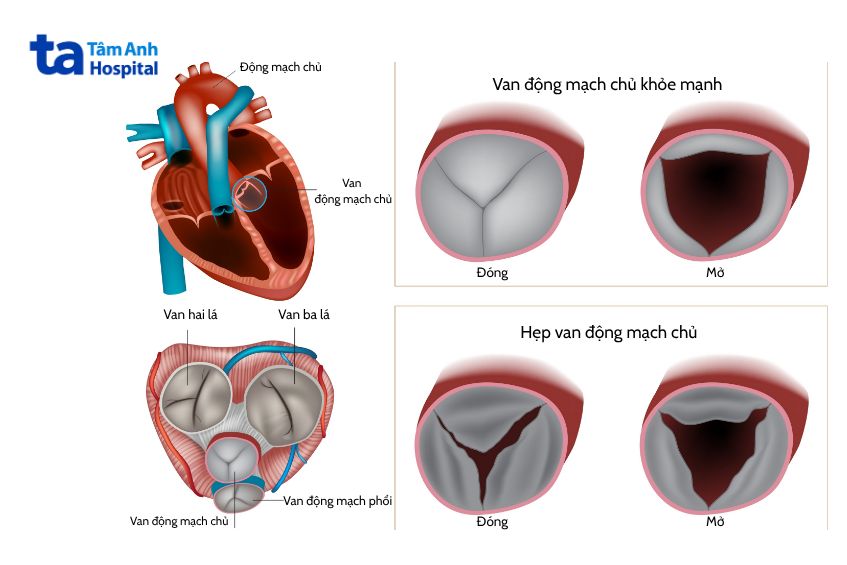 Mô tả tình trạng hẹp van tim