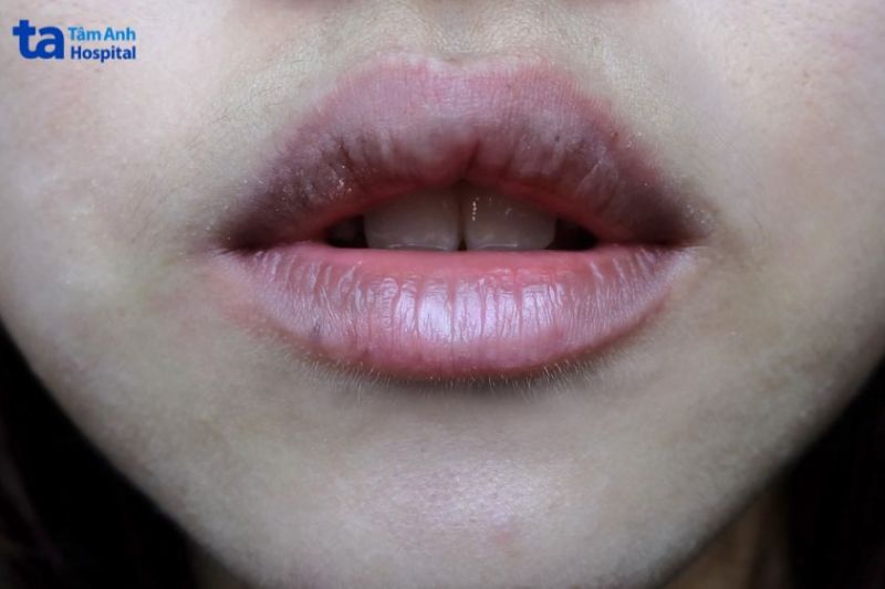hình ảnh môi bị thâm