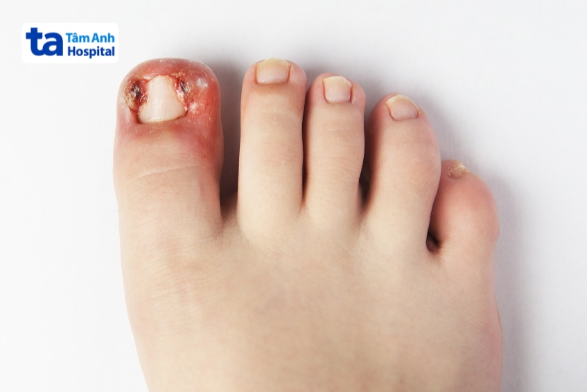 móng chân mọc ngược gây viêm, sưng, tấy đỏ