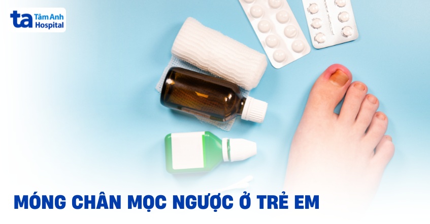 Móng chân mọc ngược ở trẻ em: Nguyên nhân, dấu hiệu, cách xử lý
